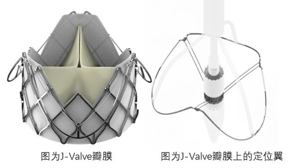 J-Valve瓣膜上的定位翼完全張開，可以找到主動脈竇并能自我調(diào)整對準瓣膜植入點；杰成將這一過程命名為“自主導航定位系統(tǒng)”