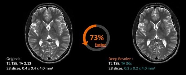 Deep Resolve可將顱腦掃描時間降低70%，并將成像分辨率提高2倍，并可保持相同的圖像質(zhì)量